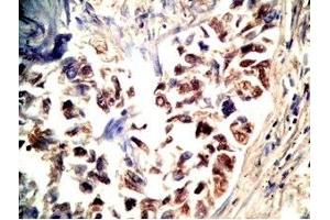 Human lung cancer tissue stained by Rabbit Anti-CRAMP(140-173) (Mouse) Antibody (Cathelicidin 抗体  (AA 140-173))
