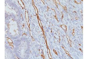 Formalin-fixed, paraffin-embedded human Colon Carcinoma stained with CD31 Mouse Monoclonal Antibody (JC/70A)