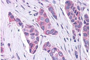 Anti-GPR30 antibody  ABIN1048795 IHC staining of human breast carcinoma. (GPER 抗体  (C-Term))