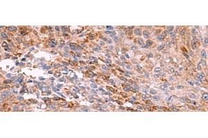 Immunohistochemistry of paraffin-embedded Human colorectal cancer tissue using PEMT Polyclonal Antibody at dilution of 1:55(x200) (PEMT 抗体)