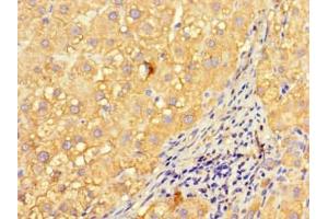Immunohistochemistry of paraffin-embedded human liver cancer using ABIN7157008 at dilution of 1:100 (Inversin 抗体  (AA 1-101))