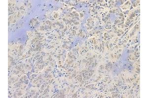 ABIN6256265 and ABIN6267506 at 1/100 staining human lung adenocarcinoma by IHC-P.
