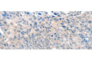 Immunohistochemistry of paraffin-embedded Human cervical cancer tissue using SLC17A6 Polyclonal Antibody at dilution of 1:100(x200) (Solute Carrier Family 17 (Vesicular Glutamate Transporter), Member 6 (SLC17A6) 抗体)
