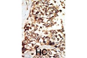 Formalin-fixed and paraffin-embedded human cancer tissue reacted with the primary antibody, which was peroxidase-conjugated to the secondary antibody, followed by DAB staining. (PKD2 抗体  (C-Term))