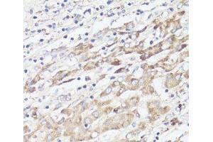 Immunohistochemistry of paraffin-embedded Human liver cancer using IGFBP1 Polyclonal Antibody at dilution of 1:100 (40x lens). (IGFBPI 抗体)