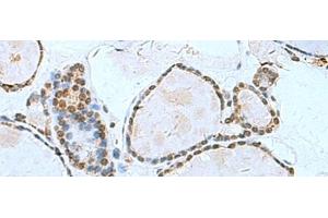 Immunohistochemistry of paraffin-embedded Human thyroid cancer tissue using L3MBTL2 Polyclonal Antibody at dilution of 1:70(x200) (L3MBTL2 抗体)