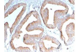 Formalin-fixed, paraffin-embedded human Prostate Carcinoma stained with ICOS-L Mouse Monoclonal Antibody (ICOSL/3111).
