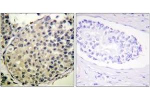 Immunohistochemistry analysis of paraffin-embedded human breast carcinoma, using eIF4G (Phospho-Ser1108) Antibody. (EIF4G1 抗体  (pSer1148))