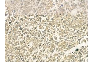 ABIN6254902 and ABIN6267061 at 1/100 staining human non-Hodgkin lymphoma by IHC-P. (NF-kB p65 抗体  (acLys310))