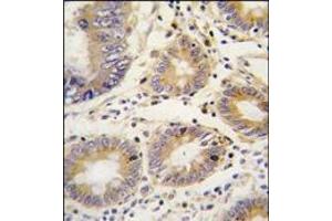 Formalin-fixed and paraffin-embedded human colon carcinoma tissue reacted with LEFTB antibody (C-term), which was peroxidase-conjugated to the secondary antibody, followed by DAB staining. (LEFTY1 抗体  (C-Term))