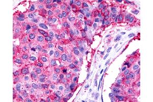 Anti-TPRA1 / GPR175 antibody IHC of human Breast, Carcinoma. (GPR175 抗体  (Cytoplasmic Domain))