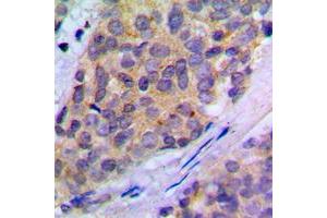 Immunohistochemical analysis of PLA2G4A (pS505) staining in human breast cancer formalin fixed paraffin embedded tissue section. (PLA2G4A 抗体  (pSer505))