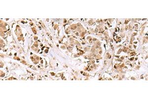 Immunohistochemistry of paraffin-embedded Human breast cancer tissue using INSM1 Polyclonal Antibody at dilution of 1:50(x200)