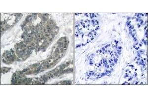 Immunohistochemistry analysis of paraffin-embedded human breast carcinoma tissue, using p62 Dok (Ab-398) Antibody. (DOK1 抗体  (AA 365-414))