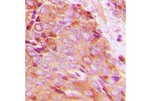 Immunohistochemical analysis of 14-3-3 zeta (pT232) staining in human breast cancer formalin fixed paraffin embedded tissue section. (14-3-3 zeta 抗体  (C-Term, pThr232))