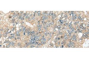 Immunohistochemistry of paraffin-embedded Human gastric cancer tissue using CASR Polyclonal Antibody at dilution of 1:60(x200) (CASR 抗体)