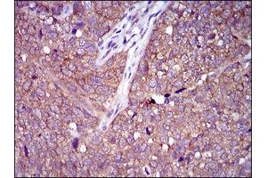 Immunohistochemical analysis of paraffin-embedded bladder cancer tissues using CLGN mouse mAb with DAB staining. (Calmegin 抗体  (AA 249-405))