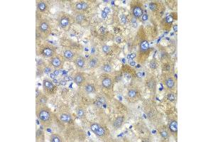 Immunohistochemistry of paraffin-embedded human liver injury using TLK2 antibody at dilution of 1:100 (x40 lens). (TLK2 抗体)