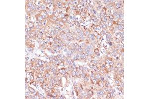 Immunohistochemistry of paraffin-embedded human liver cancer using Y antibody (ABIN6132787, ABIN6150315, ABIN6150320 and ABIN6214108) at dilution of 1:100 (40x lens).