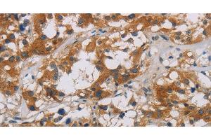 Immunohistochemistry of paraffin-embedded Human thyroid cancer using CNDP1 Polyclonal Antibody at dilution of 1:30 (CNDP1 抗体)