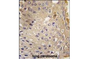 Formalin-fixed and paraffin-embedded human lung carcinoma tissue reacted with G9L1 Antibody  1814i , which was peroxidase-conjugated to the secondary antibody, followed by DAB staining. (ATG9A 抗体  (AA 723-753))
