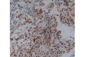 Used in DAB staining on fromalin fixed paraffin- embedded skin cancer tissue (FOS 抗体  (AA 55-298))