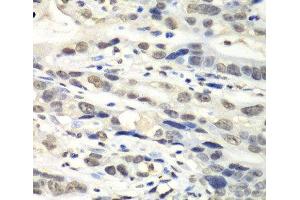 Immunohistochemistry of paraffin-embedded Human gastric cancer using NUDT1 Polyclonal Antibody at dilution of 1:100 (40x lens). (NUDT1 抗体)