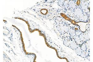 ABIN6260321 and ABIN6277297 at 1/100 staining Human esophageal cancer and adjacent normal tissues by IHC-P. (Betacellulin 抗体  (N-Term))