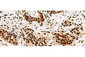 Immunohistochemistry of paraffin-embedded Human esophagus cancer tissue using HNRNPA3 Polyclonal Antibody at dilution of 1:45(x200) (HNRNPA3 抗体)