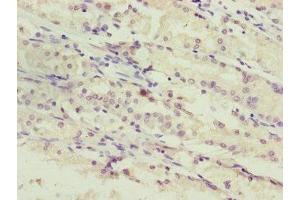 Immunohistochemistry of paraffin-embedded human gastric cancer using ABIN7169284 at dilution of 1:100 (PPP2R3C 抗体  (Regulatory Subunit B))