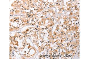 Immunohistochemistry of Human thyroid cancer using HDAC8 Polyclonal Antibody at dilution of 1:40 (HDAC8 抗体)