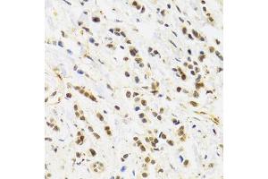 Immunohistochemistry of paraffin-embedded human breast cancer using RAD50 Antibody. (RAD50 抗体)