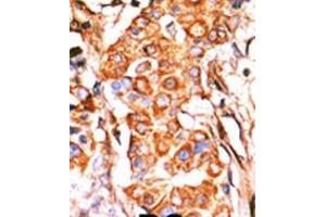 Formalin-fixed and paraffin-embedded human cancer tissue reacted with the primary antibody, which was peroxidase-conjugated to the secondary antibody, followed by AEC staining. (Glycerol Kinase 抗体  (C-Term))