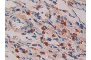 Detection of IL16 in Human Stomach cancer Tissue using Polyclonal Antibody to Interleukin 16 (IL16) (IL16 抗体  (AA 1203-1332))