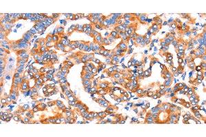 Immunohistochemistry of paraffin-embedded Human thyroid cancer tissue using SEPT4 Polyclonal Antibody at dilution 1:50 (Septin 4 抗体)