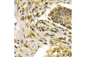 Immunohistochemistry of paraffin-embedded human esophageal cancer using IFIH1 antibody (ABIN5971229) at dilution of 1/200 (40x lens). (IFIH1 抗体)