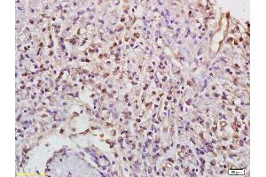 Formalin-fixed and paraffin embedded human gastric carcinoma labeled with Anti-Phospho-PKC gamma (Thr514) Polyclonal Antibody, Unconjugated (ABIN703285) at 1:200 followed by conjugation to the secondary antibody (PKC gamma 抗体  (pThr514))