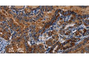 Immunohistochemistry of paraffin-embedded Human thyroid cancer tissue using PIDD1 Polyclonal Antibody at dilution 1:30 (PIDD 抗体)