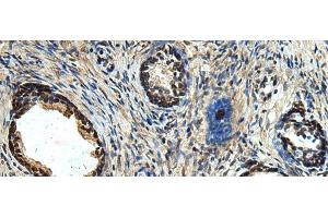 Immunohistochemistry of paraffin-embedded Human prost ate cancer tissue using ERLIN1 Polyclonal Antibody at dilution of 1:50(x200) (ERLIN1 抗体)