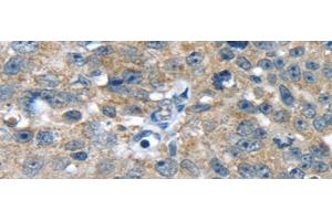 Immunohistochemistry of paraffin-embedded Human breast cancer using PBOV1 Polyclonal Antibody at dilution of 1/20 (PBOV1 抗体)