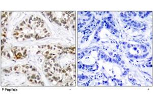 Immunohistochemical analysis of paraffin-embedded human breast carcinoma tissue using RELB (phospho S552) polyclonal antibody . (RELB 抗体  (pSer552))