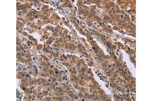 Immunohistochemistry of Human liver cancer using FAM3B Polyclonal Antibody at dilution of 1:40 (FAM3B 抗体)