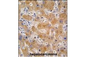 Formalin-fixed and paraffin-embedded human hepatocarcinoma tissue reacted with OA4 antibody (N-term) 7591a , which was peroxidase-conjugated to the secondary antibody, followed by DAB staining. (APOA4 抗体  (N-Term))