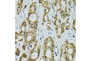 Immunohistochemistry of paraffin-embedded human rectal cancer using RPS7 antibody (ABIN5974069) at dilution of 1/100 (40x lens). (RPS7 抗体)