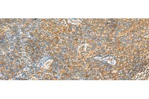 Immunohistochemistry of paraffin-embedded Human tonsil tissue using MTHFD2L Polyclonal Antibody at dilution of 1:30(x200) (MTHFD2L 抗体)