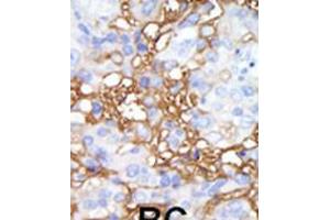 Formalin-fixed and paraffin-embedded human cancer tissue reacted with the primary antibody, which was peroxidase-conjugated to the secondary antibody, followed by DAB staining. (MAP4K1 抗体  (C-Term))