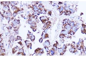 Immunohistochemistry of paraffin-embedded Human liver cancer using SHMT2 Polyclonal Antibody at dilution of 1:100 (40x lens). (SHMT2 抗体)
