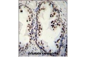 DDX27 Antibody (C-term) (ABIN655057 and ABIN2844686) immunohistochemistry analysis in formalin fixed and paraffin embedded human prsotate carcinoma followed by peroxidase conjugation of the secondary antibody and DAB staining.