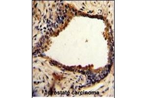 Formalin-fixed and paraffin-embedded human prostate carcinoma with NDRG1 Antibody (N-term), which was peroxidase-conjugated to the secondary antibody, followed by DAB staining. (NDRG1 抗体  (N-Term))