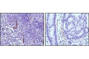 Immunohistochemical analysis of paraffin-embedded human lymph node (left) and colon cancer (right) tissues using eNOS antibody with DAB staining. (ENOS 抗体)
